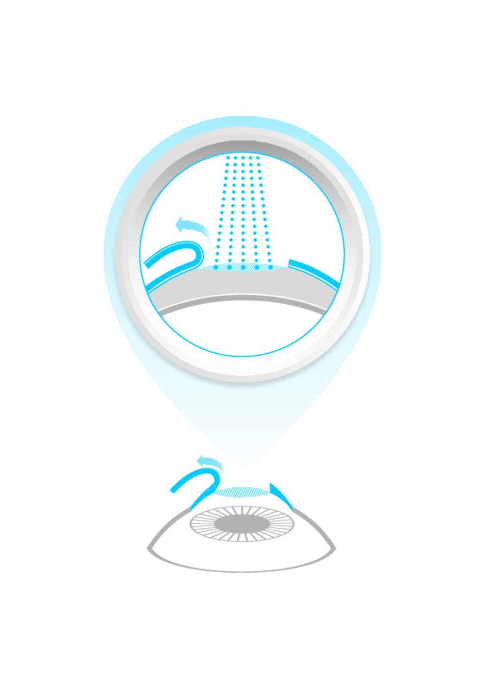 LASIK Treatment Schematic Graphic (med-zoom)